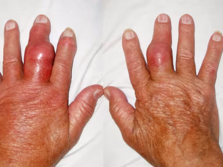 natural remedies for gout