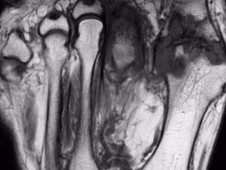 natural remedies for gout